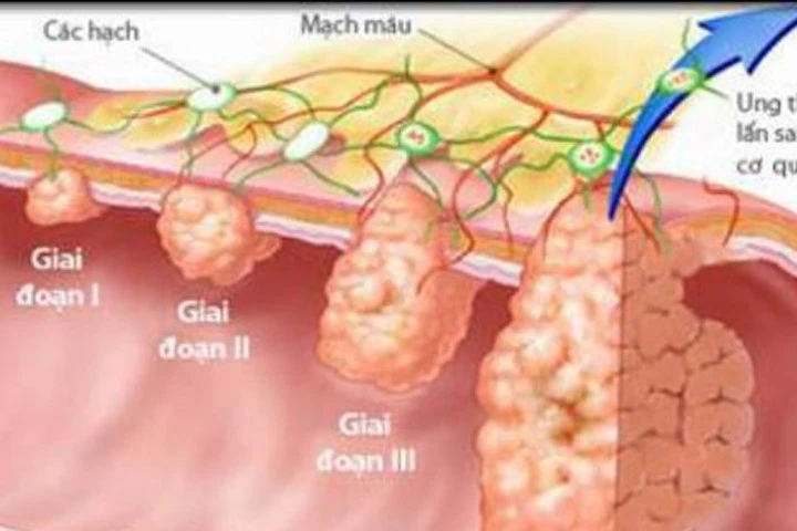 Ngăn ngừa ung thư dạ dày bằng những thực phẩm dân dã sau