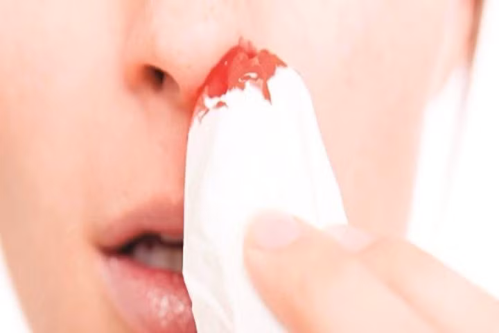 Tự nhiên chảy máu cam, dấu hiệu của nhiều bệnh về mũi