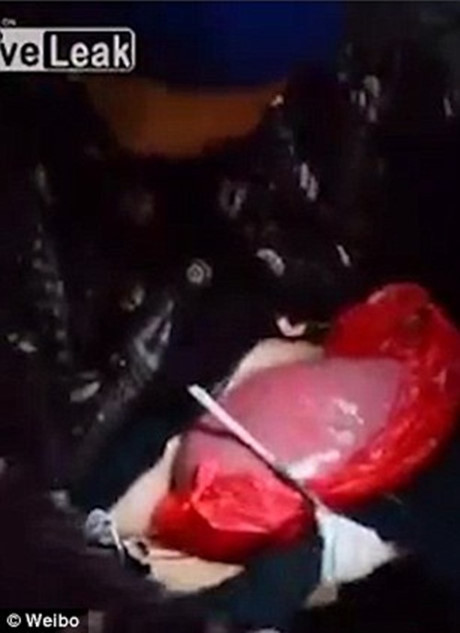 Cu ba song hang thap ky voi tinh trang ruot loi ben ngoai co the - Anh 3