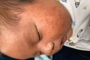 Bệnh viêm da cơ địa ở trẻ em. Ảnh minh họa.