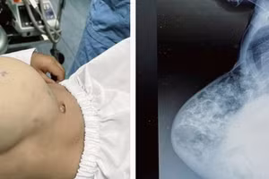 Bệnh nhi bị thoát vị thành bụng lớn kèm dị tật ruột xoay dở dang. Nguồn: BV.