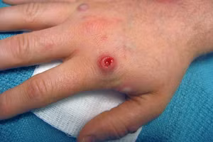 Vết phát ban mưng mủ đặc trưng của người mắc đậu mùa khỉ. 