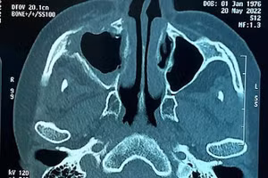 Phim chụp bệnh nhân bị hoại tử xương sọ. Ảnh: Bệnh viện Chợ Rẫy.