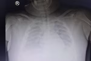 Xquang phổi cho thấy trẻ bị tràn dịch màng phổi và tổn thương phổ 2 bên. Ảnh: BV.
