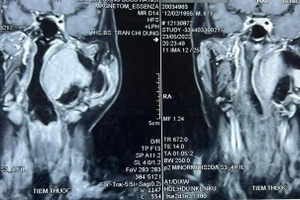 Hình ảnh chụp cộng hưởng từ khối u khoảng bên họng của bệnh nhân. Nguồn: BV.