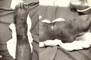 Bàn chân của bệnh nhân sau nối. Ảnh: BV.