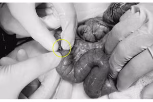 Viên bi nam châm được các bác sĩ lấy ra thành công từ đoạn ruột bị thủng của bé gái Ảnh: BV.