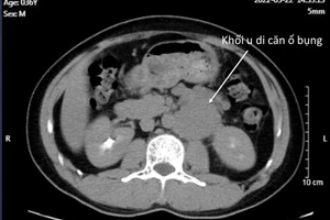 Thờ ơ với dấu hiệu này, người đàn ông 36 tuổi đi khám phát hiện ung thư đã di căn