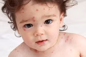 Thủy đậu là bệnh truyền nhiễm thường gặp từ tháng 2-6 trong năm. Ảnh: Internet.