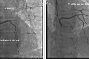 Hình ảnh chụp động mạch vành trước và sau khi can thiệp. Ảnh: BV.