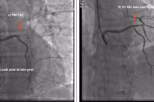 Hình ảnh chụp động mạch vành trước và sau khi can thiệp. Ảnh: BV.