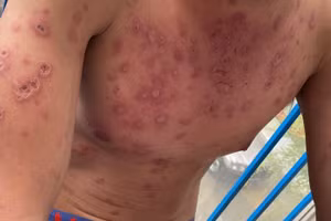 Cơ thể bệnh nhân nổi nhiều dát, sẩn, mảng hồng ban do bị hội chứng Rowell. Ảnh: BV.