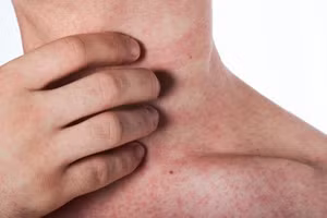 Xuất huyết dưới da được biểu hiện những nốt xuất huyết rải rác. Nguồn: BV Vinmec.