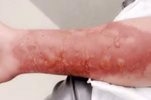 Bỏng là tai nạn thường gặp trong đời sống sinh hoạt và lao động. Nguồn: Bệnh viện đa khoa tỉnh Phú Thọ.