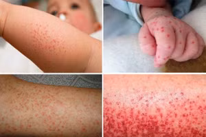 Da trẻ xuất hiện nốt xuất huyết là dấu hiệu dễ nhận thấy khi bị sốt xuất huyết. Ảnh: BV.