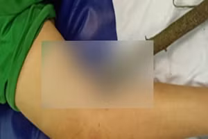 Phẫu thuật thành công bé trai 11 tuổi bị cành cây đâm xuyên đùi