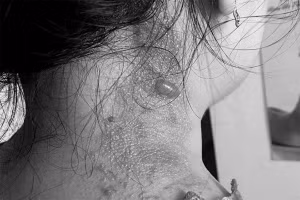 Một trường hợp viêm da do tiếp xúc với kiến ba khoang nhưng được nhân viên nhà thuốc chẩn đoán thành bệnh Zona khiến bệnh nặng hơn. Ảnh: Bệnh viện Da Liễu TP Hồ Chí Minh.