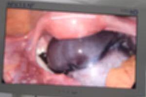 Nội soi cắt u buồng trứng xoắn và ruột thừa cho bé gái 14 tuổi