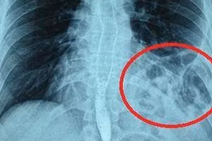 Phim X-quang cho thấy bóng khí của đại tràng ở trên ngực trái bệnh nhân. Ảnh: BV.