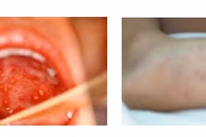 Cách chăm sóc trẻ bệnh tay chân miệng tại nhà