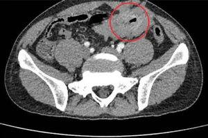 Hình chụp CT Scan phát hiện khối u GIST ruột non bị thủng. 