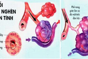 Nguyên nhân và cách điều trị bệnh phổi tắc nghẽn mạn tính