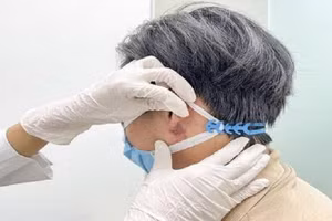 Dái tai bệnh nhân biến dạng nặng sau khi tiêm filler. Ảnh: BV.