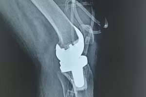 Hình ảnh khớp gối nhân tạo của bệnh nhân. Ảnh: BVCC.