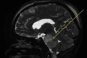 Bác sĩ xác định khối u nằm ngay phần cuống não chịu trách nhiệm kiểm soát các dây thần kinh và nhóm cơ thường gây ra phản ứng nấc cụt. Ảnh: Daily Mail.