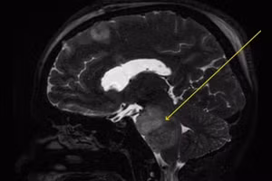 Bác sĩ xác định khối u nằm ngay phần cuống não chịu trách nhiệm kiểm soát các dây thần kinh và nhóm cơ thường gây ra phản ứng nấc cụt. Ảnh: Daily Mail.