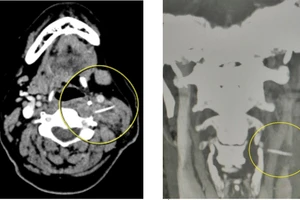 Hình ảnh chụp cắt lớp vi tính vị trí xương cá trong vùng cổ bệnh nhân. Nguồn: Bệnh viện đa khoa tỉnh Thanh Hóa.
