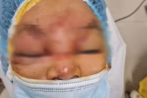 Mắt phải của bé trai bị thương nặng, mất thị lực hoàn toàn, phần mi dưới rách. Ảnh: BVMTN.