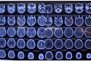 Hình ảnh chảy máu thân não trên cắt lớp vi tính sọ não.