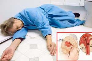 Những lưu ý khi sơ cứu người bệnh đột quỵ an toàn