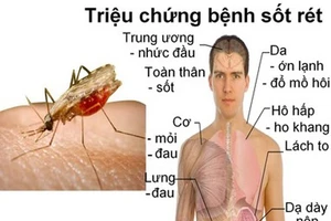 Triệu chứng bệnh sốt rét. Ảnh: SKĐS.