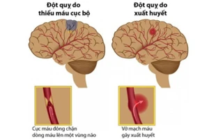 Nguyên nhân gây đột quỵ là do sự bất ổn của tuần hoàn máu não. Nguồn: Bệnh viện Đa khoa tỉnh Lạng Sơn.