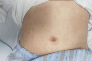 Hình ảnh ban đỏ rải rác toàn thân trẻ. Ảnh: BV.