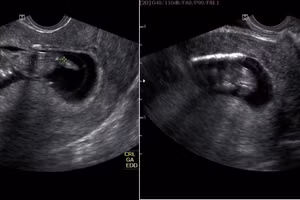 Lấy vòng tránh thai cho thai phụ 12 tuần