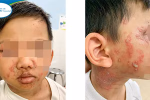 Nguồn: BV Nhi Trung ương.