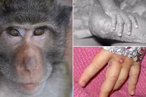 WHO giải đáp các thông tin cơ bản về bệnh đậu mùa khỉ