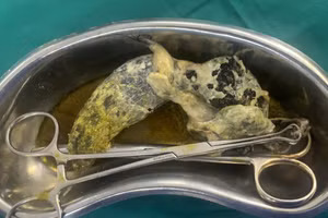 Phần búi tóc khổng lồ đã được các bác sĩ lấy ra. Nguồn: Bệnh viện Nhi đồng 2.