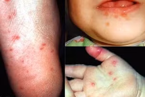 Xuất hiện những dấu hiệu này khi mắc tay chân miệng, cần đến bệnh viện ngay