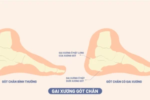 Chuyên gia y tế liệt kê 5 cách hiệu quả ngăn ngừa gai xương