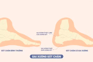 Chuyên gia y tế liệt kê 5 cách hiệu quả ngăn ngừa gai xương