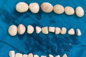 Sỏi được lấy ra khỏi bàng quang bệnh nhân. Ảnh: BV.