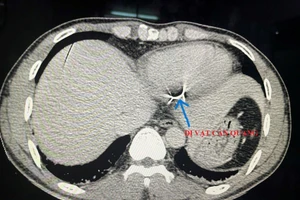 Hình ảnh chụp cắt lớp phát hiện dị vật trong tim bệnh nhân. Ảnh: BV.