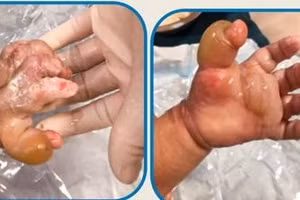 Bố mẹ ân hận vì tự chữa bỏng cho con theo cách này