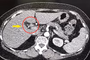 Can thiệp thành công nội soi mật tụy ngược dòng hiếm gặp
