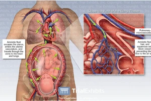 Sản phụ tử vong tại bệnh viện tư, nghi do thuyên tắc ối (ảnh: ITN).