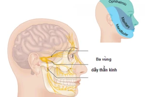 Liệt dây thần kinh số 7.